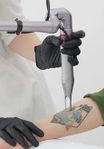 Tatueringsborttagning med modern laserteknik